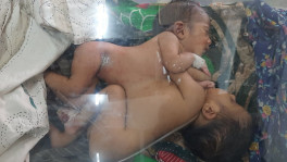 ওসমানী হাসপাতালে জোড়া লাগানো কন্যা শিশুর জন্ম