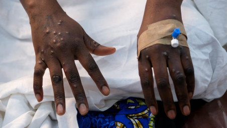 The hands of a patient with a skin rash caused by the MPox virus are seen at the Vijana Hospital treatment center in Kinshasa, Democratic Republic of the Congo, August 30, 2024. Photo: REUTERS/Justin Makangara/File Photo